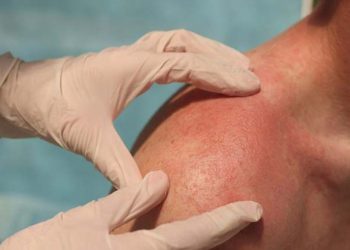 Viêm da tiếp xúc dị ứng ánh sáng (Photoallergic contact dermatitis)