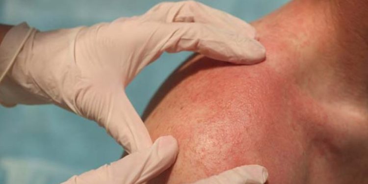 Viêm da tiếp xúc dị ứng ánh sáng (Photoallergic contact dermatitis)