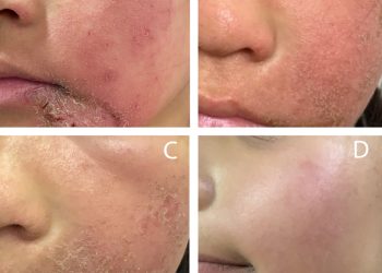 Nghiện Corticoid bôi tại chỗ