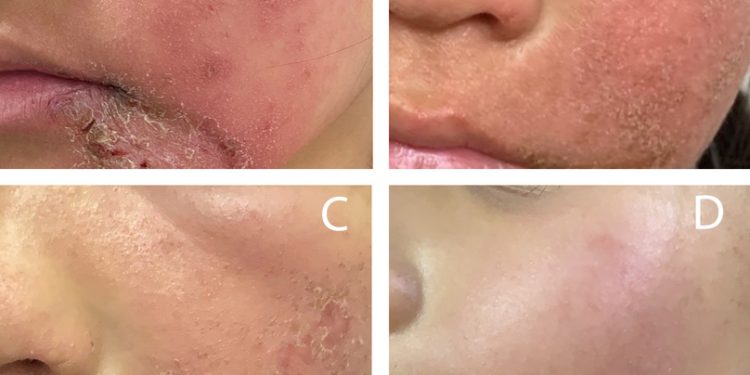 Nghiện Corticoid bôi tại chỗ